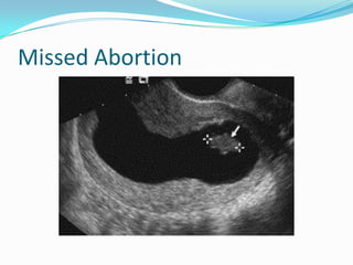 Missed Abortion
 
