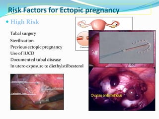 Risk Factors for Ectopic pregnancy
 High Risk

 Moderate Risk
  Infertility
  Multiple sexual partners
  Previous genita...