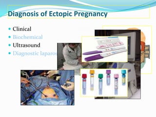SONOGRAPHY
                   Early intrauterine pregnancy
 Earliest sign ~ small fluid collection in the
 endometrium
 