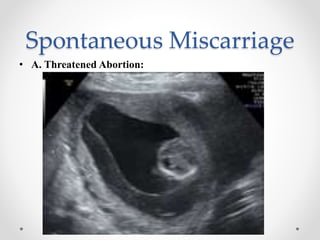 Spontaneous Miscarriage
• A. Threatened Abortion:
 