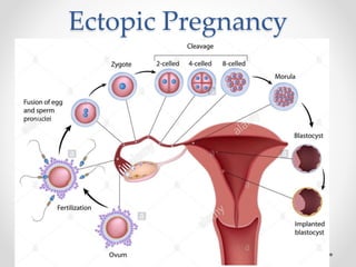 Ectopic Pregnancy
• 1- Introduction:
• Physiology of pregnancy and implantation :
 