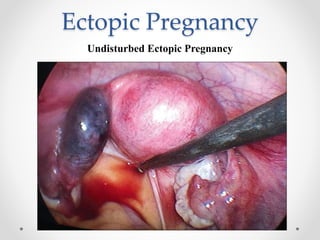 Ectopic Pregnancy
Undisturbed Ectopic Pregnancy
 