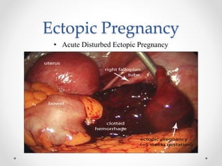 Ectopic Pregnancy
• Acute Disturbed Ectopic Pregnancy
 
