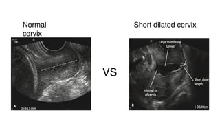 VS
Normal
cervix
Short dilated cervix
 