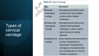 Types of
cervical
cerclage
Y
 
