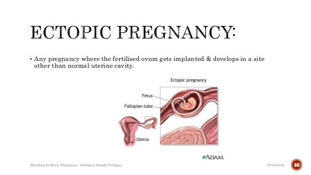 Listen to This.. 12+  What You Did NOT Know About  Pictures Of Spotting During Pregnancy! Signs and symptoms of an ectopic pregnancy may include abdominal pain, lack of menstrual period (amenorrhea), vaginal bleeding, fainting, dizziness, and low blood pressure.