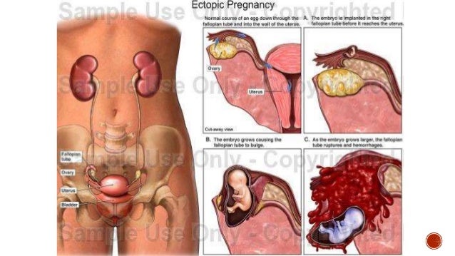 Bleeding in early pregnancy Bleeding in early pregnancy