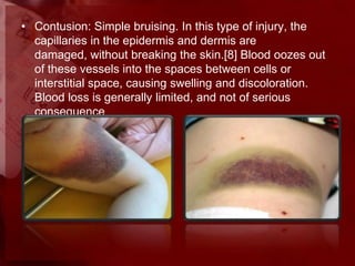 Bleeding management | PPTX