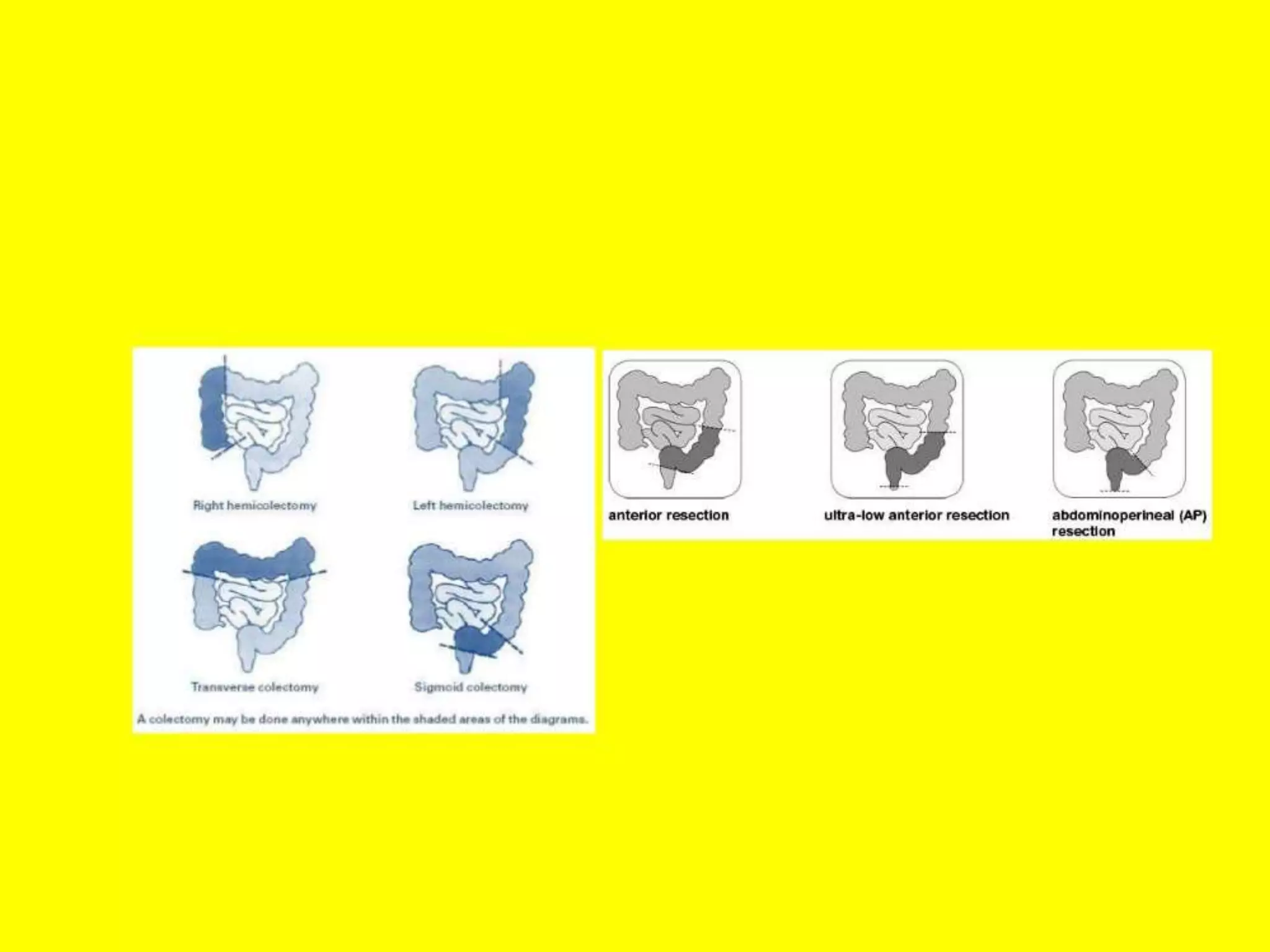 Bleeding per rectum basic medical knowledge management ppt