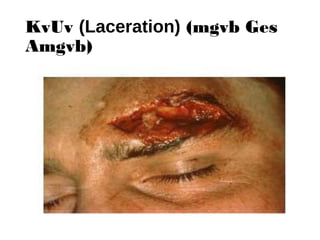 KvUv (Laceration) (mgvb Ges
Amgvb)
 