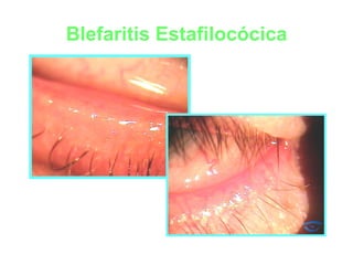 Blefaritis Estafilocócica 