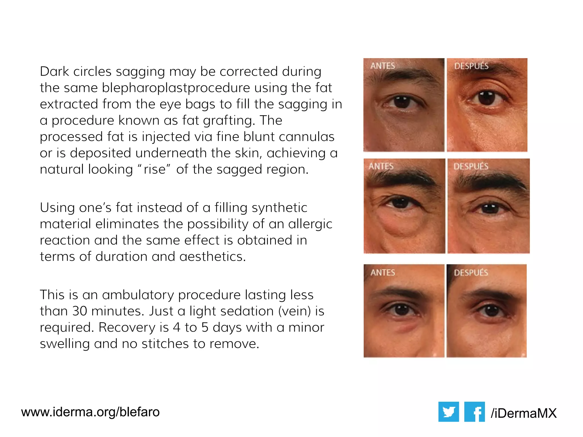 Blefaro: english | PPT