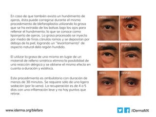 En caso de que también exista un hundimiento de
  ojeras, ésta puede corregirse durante el mismo
  procedimiento de blefaroplastía utilizando la grasa
  que se ha extraído de las bolsas bajo los ojos para
  rellenar el hundimiento; lo que se conoce como
  lipoinjerto de ojeras. La grasa procesada se inyecta
  por medio de finas cánulas romas y se depositan por
  debajo de la piel, logrando un “levantamiento” de
  aspecto natural dela región hundida.


  El utilizar la grasa de uno mismo en lugar de un
  material de relleno sintético elimina la posibilidad de
  una reacción alérgica y se obtiene el mismo efecto en
  cuanto a duración y estética.


  Este procedimiento es ambulatorio con duración de
  menos de 30 minutos. Se requiere sólo de una ligera
  sedación (por la vena). La recuperación es de 4 a 5
  días con una inflamación leve y no hay puntos que
  retirar.




www.iderma.org/blefaro                                      /iDermaMX
 