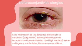 Blefaroconjuntivitis alergica
Es la inflamación de los párpados (blefaritis) y la
conjuntiva (conjuntivitis) desencadenada por una
respuesta de hipersensibilidad tipo I (IgE mediada) frente
a alérgenos ambientales, fármacos o cosméticos
 