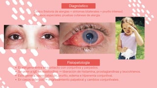 Diagnóstico
Fisiopatologia
El alérgeno entra en contacto con conjuntiva y párpados.
Se unen a IgE en mastocitos →liberación de histamina, prostaglandinas y leucotrienos.
Esto genera: vasodilatación, prurito, edema e hiperemia conjuntival.
En casos crónicos →engrosamiento palpebral y cambios conjuntivales.
Clínico (historia de alergias + síntomas bilaterales + prurito intenso).
En casos especiales: pruebas cutáneas de alergia.
 