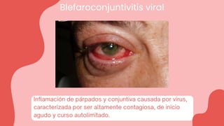 Blefaroconjuntivitis viral
Inflamación de párpados y conjuntiva causada por virus,
caracterizada por ser altamente contagiosa, de inicio
agudo y curso autolimitado.
 