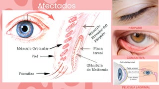 Afectados
PARPADO
CONJUNTIVA
PELICULA LAGRIMAL
 