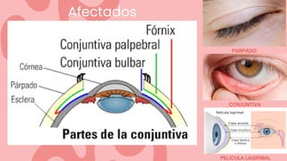 Afectados
PARPADO
CONJUNTIVA
PELICULA LAGRIMAL
 