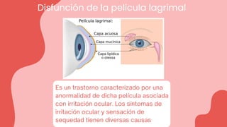 Disfunción de la pelicula lagrimal
Es un trastorno caracterizado por una
anormalidad de dicha película asociada
con irritación ocular. Los síntomas de
irritación ocular y sensación de
sequedad tienen diversas causas
 
