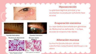 Hiposecreción
La glándula lagrimal principal y las
accesorias no producen suficiente fase
acuosa
Evaporación excesiva
La capa lipídica (secretada por glándulas
de Meibomio) es deficiente →la fase
acuosa se evapora más rápido.
Alteración mucosa
La mucina (producida por células
caliciformes conjuntivales) disminuye o se
altera
 