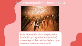 Blefaroconjuntivitis Bacteriana
Es la inflamación mixta de párpados
(blefaritis) y conjuntiva (conjuntivitis)
causada por infección bacteriana, que
suele ser crónica y recurrente
 