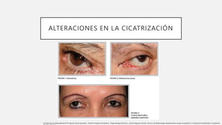 ALTERACIONES EN LA CICATRIZACIÓN
Complicaciones blefaroplastia Nº:33 Ignacio Genol Saavedra1 , Nicolás Toledano Fernández1 , Ángel Arteaga Sánchez2 , Araceli Nogueira Goriba1 Servicio de Oftalmología. Departamento cirugía oculoplástica 1 Hospital de Fuenlabrada 2 Hospital de
 