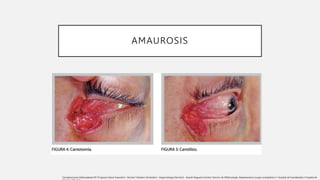 AMAUROSIS
Complicaciones blefaroplastia Nº:33 Ignacio Genol Saavedra1 , Nicolás Toledano Fernández1 , Ángel Arteaga Sánchez2 , Araceli Nogueira Goriba1 Servicio de Oftalmología. Departamento cirugía oculoplástica 1 Hospital de Fuenlabrada 2 Hospital de
 
