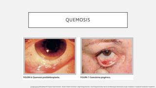 QUEMOSIS
Complicaciones blefaroplastia Nº:33 Ignacio Genol Saavedra1 , Nicolás Toledano Fernández1 , Ángel Arteaga Sánchez2 , Araceli Nogueira Goriba1 Servicio de Oftalmología. Departamento cirugía oculoplástica 1 Hospital de Fuenlabrada 2 Hospital de
 