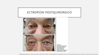 ECTROPION POSTQUIRÚRGICO
Complicaciones blefaroplastia Nº:33 Ignacio Genol Saavedra1 , Nicolás Toledano Fernández1 , Ángel Arteaga Sánchez2 , Araceli Nogueira Goriba1 Servicio de Oftalmología. Departamento cirugía oculoplástica 1 Hospital de Fuenlabrada 2 Hospital de
 