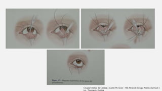 Cirugia Estetica de Cabeza y Cuello Mc Graw – Hill Altras de Cirugía Plástica Samiuel J.
Lin . Thomas A. Mustoe
 