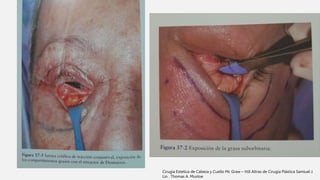 Cirugia Estetica de Cabeza y Cuello Mc Graw – Hill Altras de Cirugía Plástica Samiuel J.
Lin . Thomas A. Mustoe
 