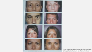 Cirugia Estetica de Cabeza y Cuello Mc Graw – Hill Altras
de Cirugía Plástica Samiuel J. Lin . Thomas A. Mustoe
 