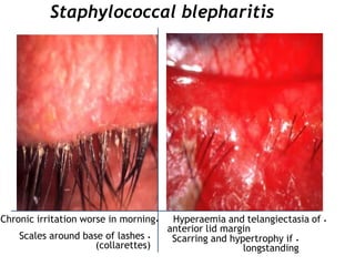 Staphylococcal blepharitis
•Hyperaemia and telangiectasia of
anterior lid margin
•Scarring and hypertrophy if
longstanding
•Scales around base of lashes
(collarettes)
•Chronic irritation worse in morning
 