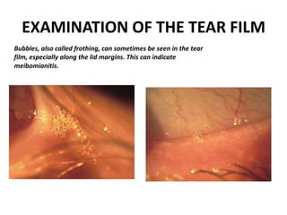 EXAMINATION OF THE TEAR FILM
Bubbles, also called frothing, can sometimes be seen in the tear
film, especially along the lid margins. This can indicate
meibomianitis.
 