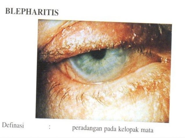 BLEPHARITIS