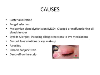 CAUSES
• Bacterial infection
• Fungal infection
• Meibomian gland dysfunction (MGD)- Clogged or malfunctioning oil
glands in your
• Eyelids Allergies, including allergic reactions to eye medications
• Contact lens solutions or eye makeup
• Parasites
• Chronic conjunctivitis
• Dandruff on the scalp