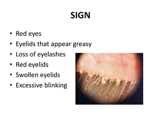 SIGN
• Red eyes
• Eyelids that appear greasy
• Loss of eyelashes
• Red eyelids
• Swollen eyelids
• Excessive blinking