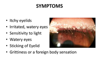 SYMPTOMS
• Itchy eyelids
• Irritated, watery eyes
• Sensitivity to light
• Watery eyes
• Sticking of Eyelid
• Grittiness or a foreign body sensation