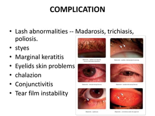 COMPLICATION
• Lash abnormalities -- Madarosis, trichiasis,
poliosis.
• styes
• Marginal keratitis
• Eyelids skin problems
• chalazion
• Conjunctivitis
• Tear film instability