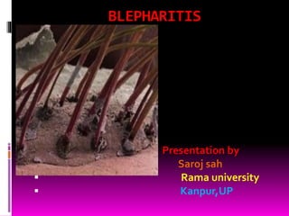 BLEPHARITIS
 Presentation by
 Saroj sah
 Rama university
 Kanpur,UP
 