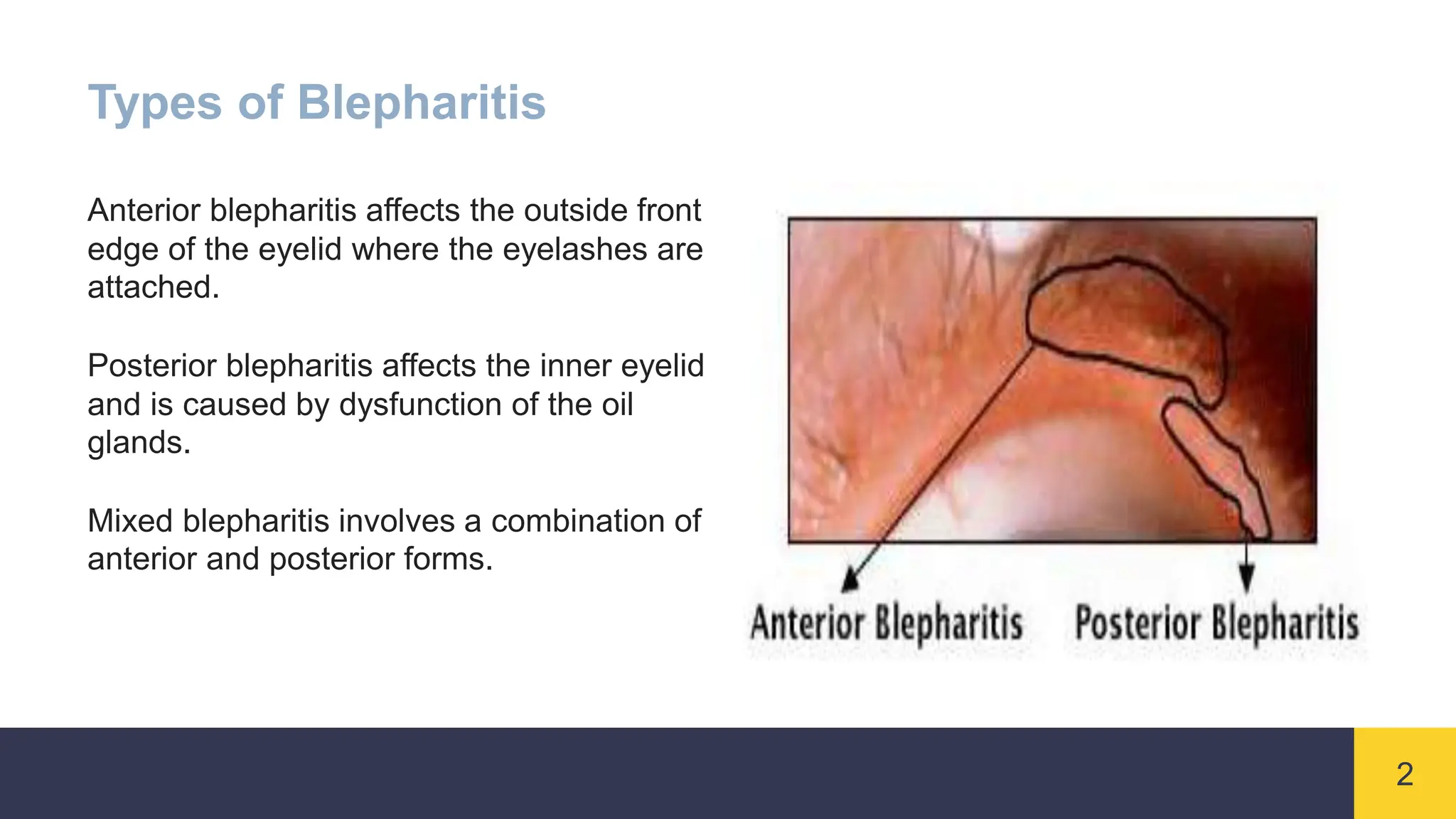 Blepharitis inflammation of eyelid symptoms cause everything included ...