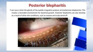 BLEPHARITIS presentation in ophthalmology.pptx