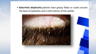 BLEPHARITIS presentation in ophthalmology.pptx