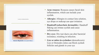 CAUSES OFANTERIOR BLEPHARITIS
• Acne rosacea: Rosacea causes facial skin
inflammation, which can include your
eyelids.
• Allergies: Allergies to contact lens solution,
eye drops or makeup can spur irritation.
• Dandruff (seborrheic dermatitis): Dandruff
flaking can irritate eyelids and cause
inflammation.
• Dry eyes: Dry tear ducts can alter bacterial
resistance, resulting in infection.
• Lice or mites in eyelashes (demodicosis):
Lice or Demodex mites can block eyelash
follicles and glands in your eye
 