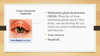 Causes of posterior
blepharitis • Meibomian gland dysfunction
(MGD): When the oil from
meibomian glands doesn’t flow
freely, you can develop dry eye,
which can result in inflammation
and infection.
• Acne rosacea.
• Dandruff.
 