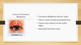 Causes of Ulcerative
Blepharitis • Ulcerative Blepharitis (Severe Type)
• This is a more serious and painful form.
• Causes sores (ulcers) on the eyelid
edges
• May bleed and form crusts
 