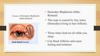 Causes of Demodex Blepharitis
(Mite-Related)
• Demodex Blepharitis (Mite-
Related)
• This type is caused by tiny mites
(Demodex) living in hair follicles.
• These mites feed on oil while you
sleep
• Can block follicles and cause
itching and irritation
 