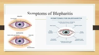 Symptoms of Blepharitis
 