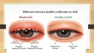 Difference between healthy eyelid and eye with
Blepharitis
 