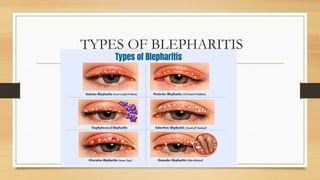 TYPES OF BLEPHARITIS
 
